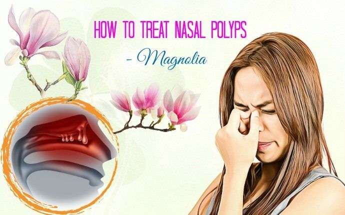 30 Tips On How To Treat Nasal Polyps Naturally At Home ...
