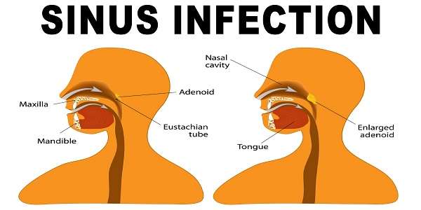 4 Home Remedies to Quickly Get Rid of Sinus Infections