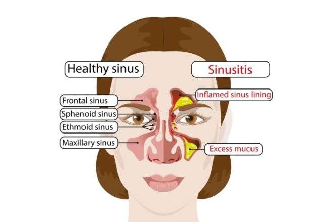 7 Common Reasons For Sinus Infection