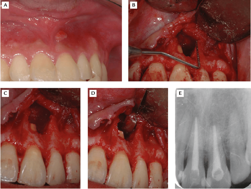 (A) Persistent sinus tract over tooth 21 after endodontic ...
