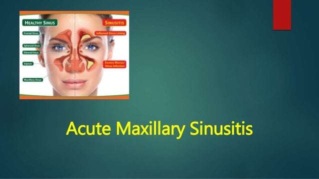 Acute sinusitis