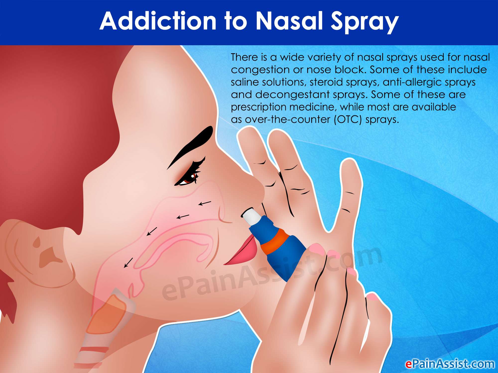 Addiction to Nasal Spray: Treatment &  Recovery of Rebound ...