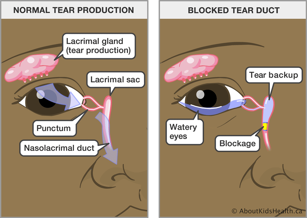 Blocked Tear Duct in babies: Meaning, Symptoms and treatment
