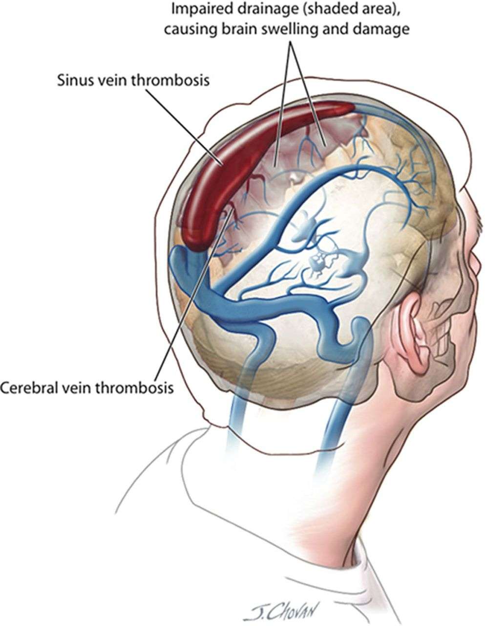 Cerebral and Sinus Vein Thrombosis