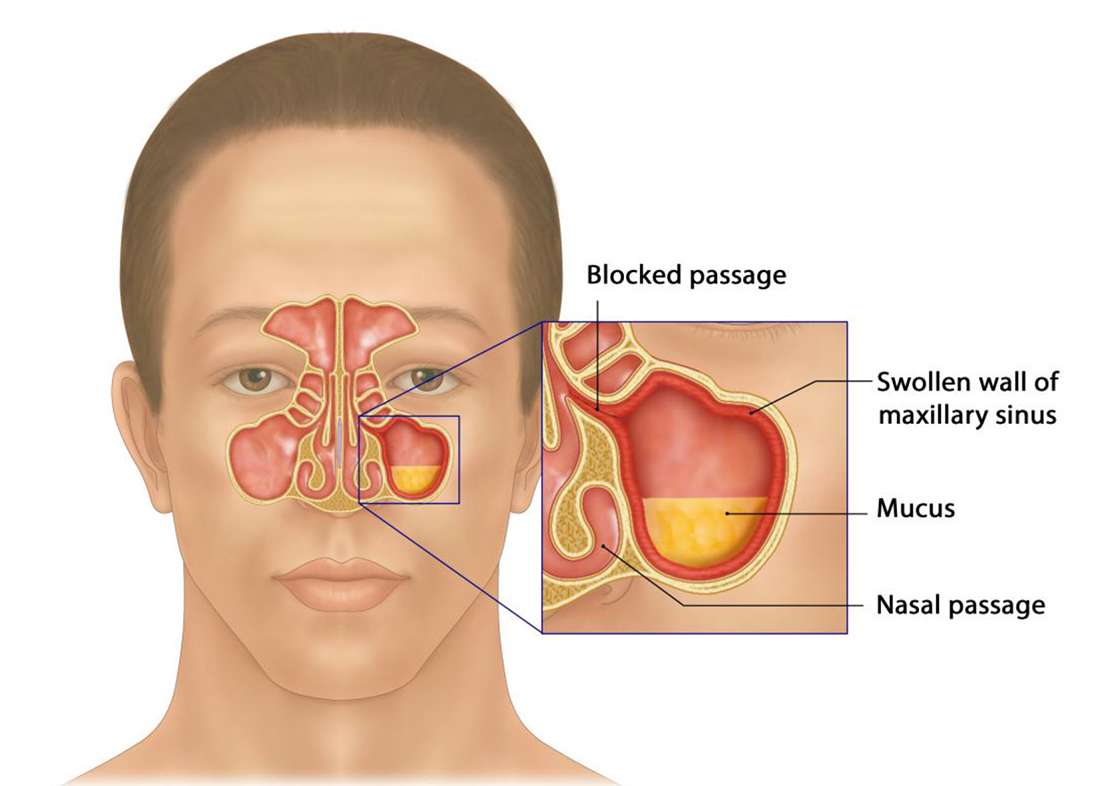 Chronic Rhinosinusitis, Nasal Polyps