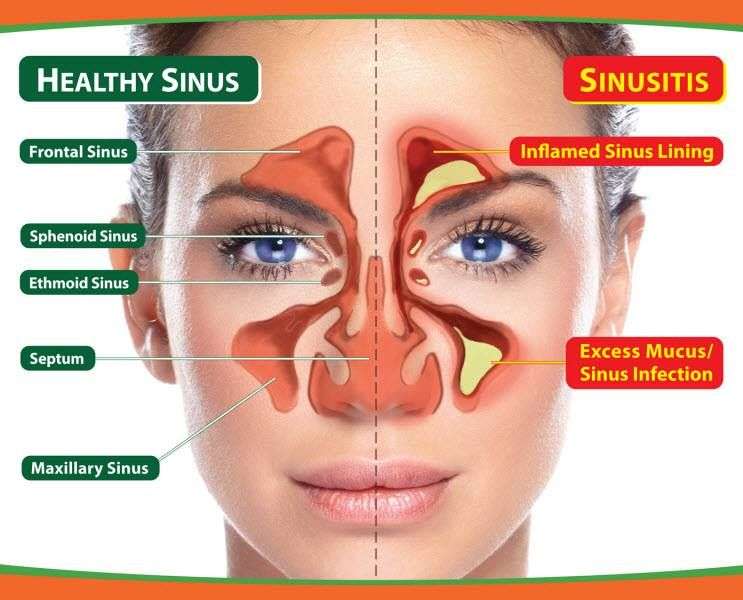 Chronic sinusitis and acute sinusitis have similar signs and symptoms ...