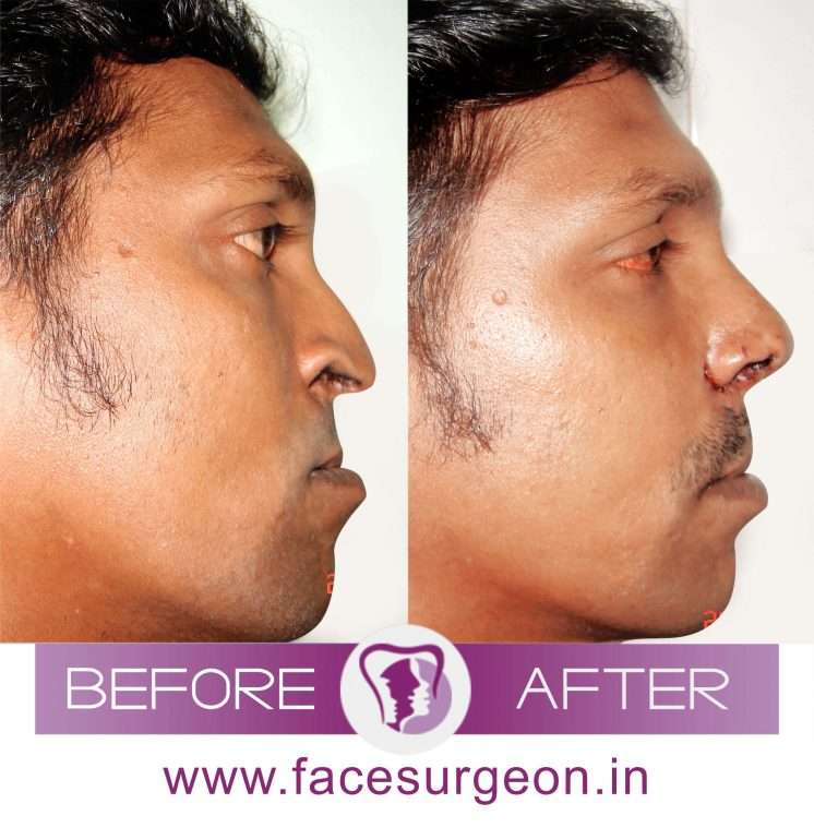 Cost of nose job in India: Cosmetic rhinoplasty in India