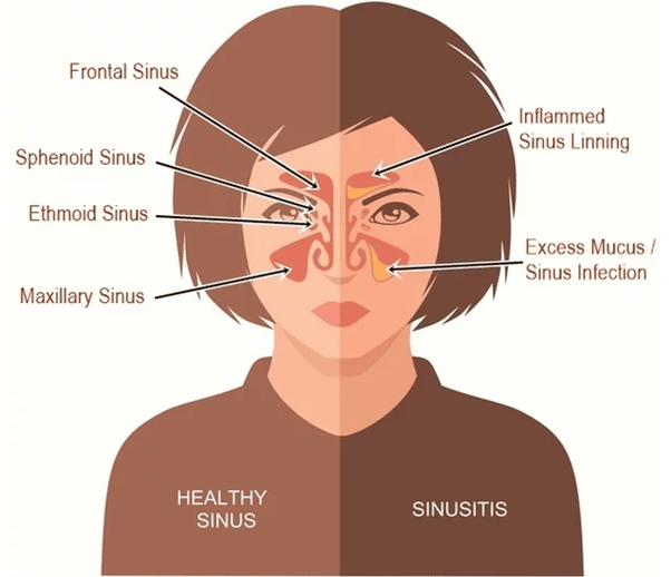 Could you please recommend me a good doctor for sinusitis in Hyderabad ...