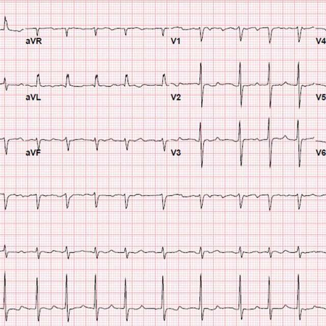 ECG immediately after cardioversion, demonstrating sinus ...