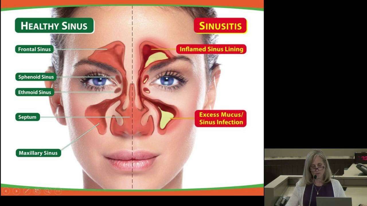 Evaluation and Management of Acute and Chronic Sinusitis ...