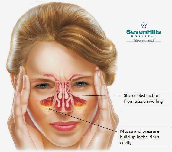 EVERYTHING ABOUT SINUSITIS YOU WANTED TO KNOW ...