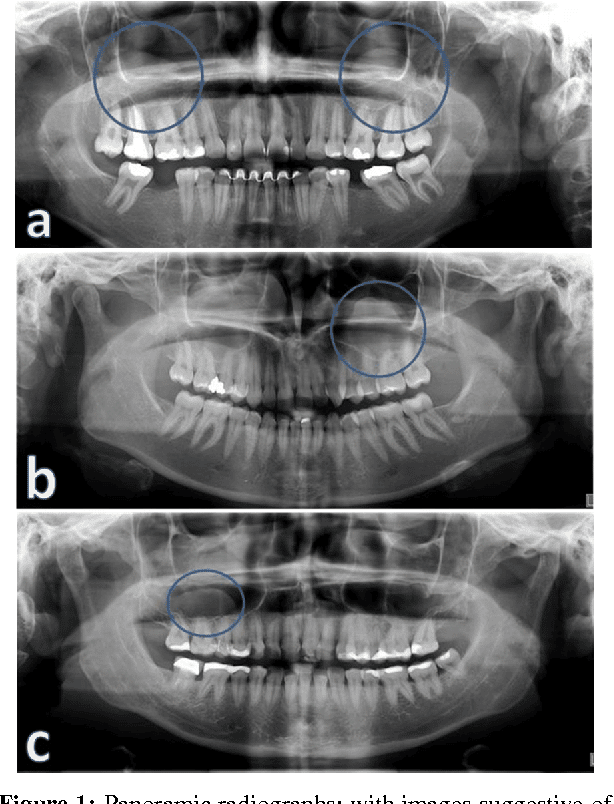 Figure 1 from Frequency of Maxillary Sinus Mucous Retention Cysts in a ...