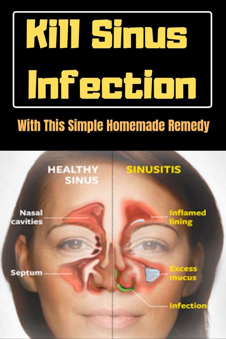 GET RID OF SINUSITIS OR ANY OTHER RESPIRATORY INFECTION ...