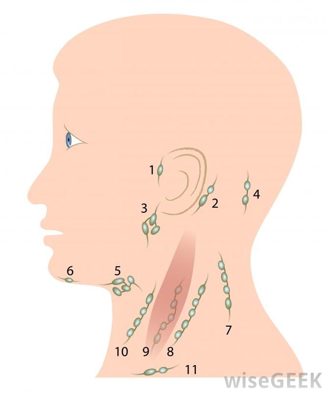 How Do I Know if I Have Swollen Lymph Nodes? (with pictures)