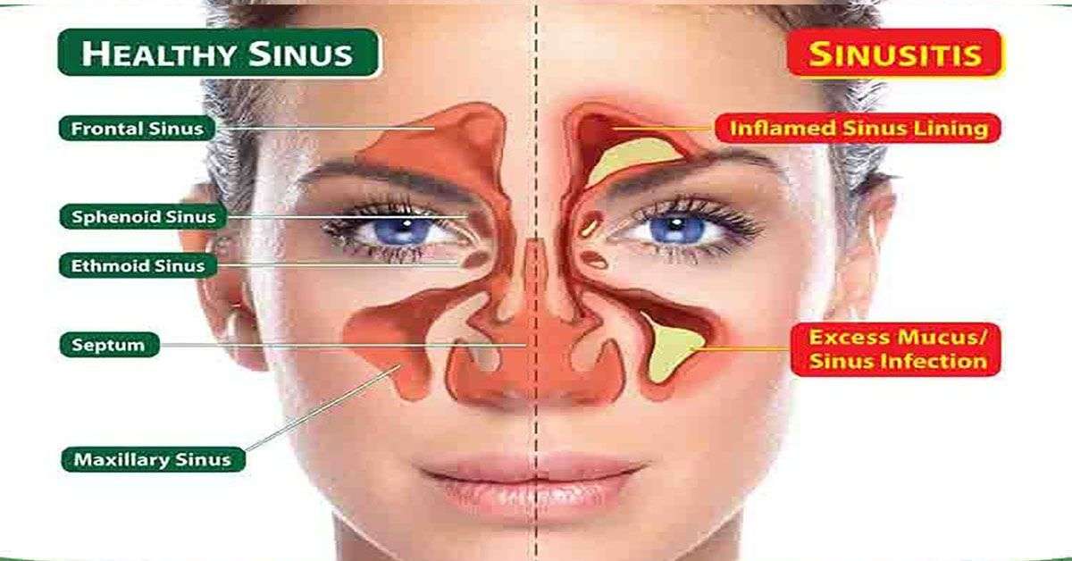 How to Clear Seriously Blocked Sinuses Naturally in 1 ...