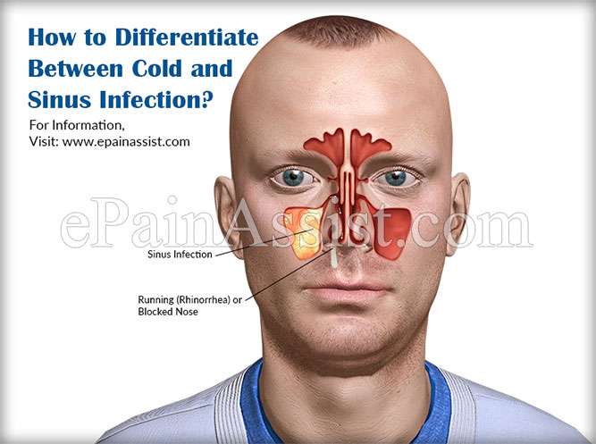 How to Differentiate Between Cold and Sinus Infection?