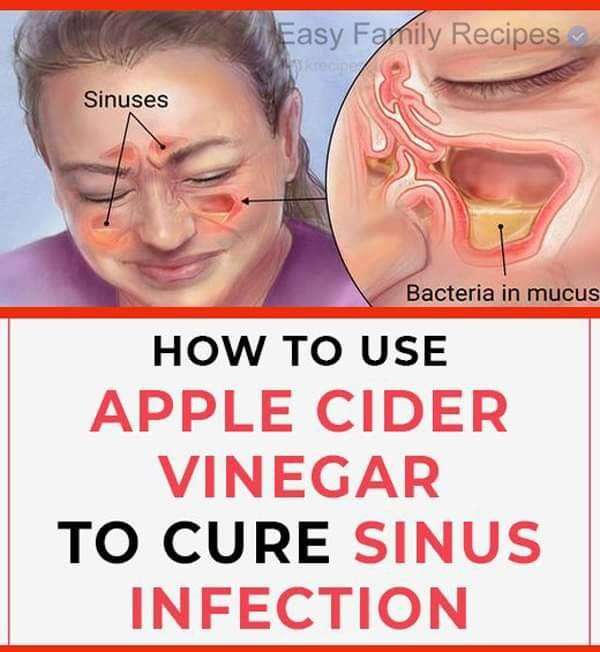 How To Kill Sinus Infection Within Minutes With Apple ...
