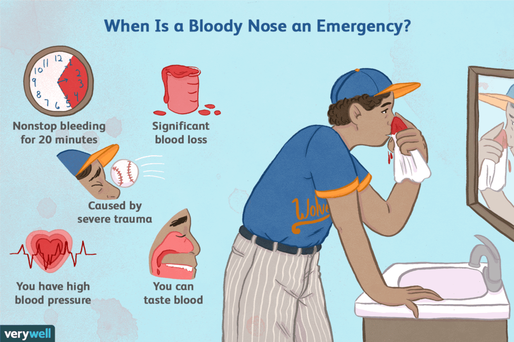 HOW TO STOP NOSEBLEED AT HOME