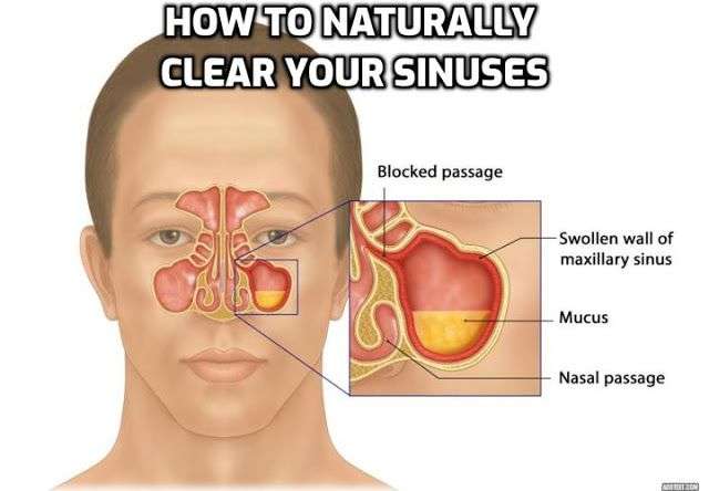 How to Treat Sinus Inflammation Without Any Nasal Spray ...
