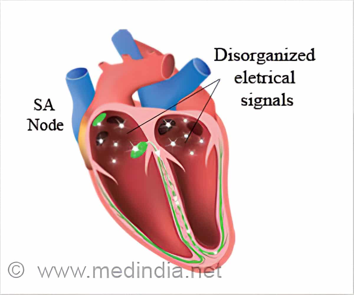 Icd 9 Code For Sick Sinus Syndrome