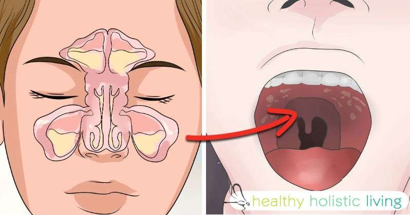 If You Get Sinus Headaches or CONSTANT Congestion You NEED ...