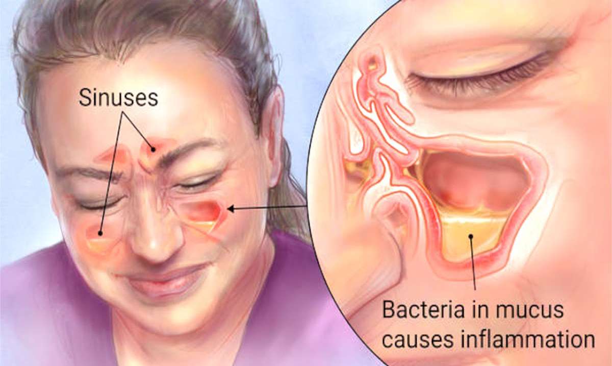 Kill Sinus Infections in 20 Seconds With This Simple ...