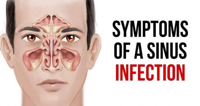 Know In Details About The Symptoms, Causes And Treatment For Sinus ...