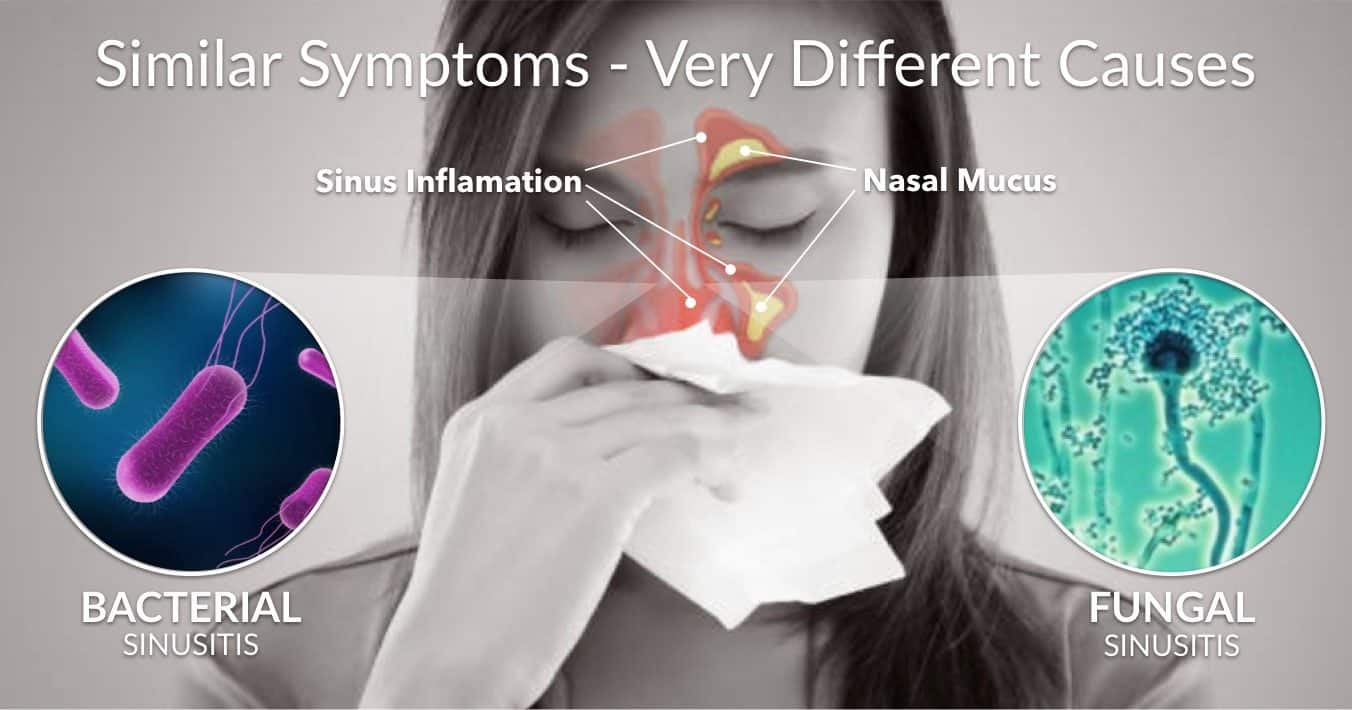 Learn about chronic sinusitis &  sinus inflammation caused ...