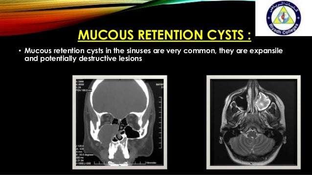 Maxillary Sinus Retention Cyst signs and symptoms