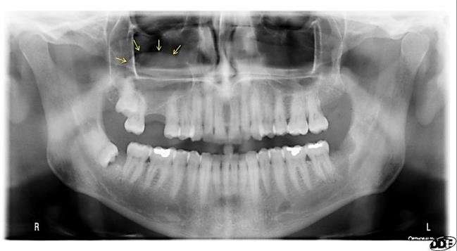 Mucous retention pseudocyst (MRP) of the right maxillary sinus on ...