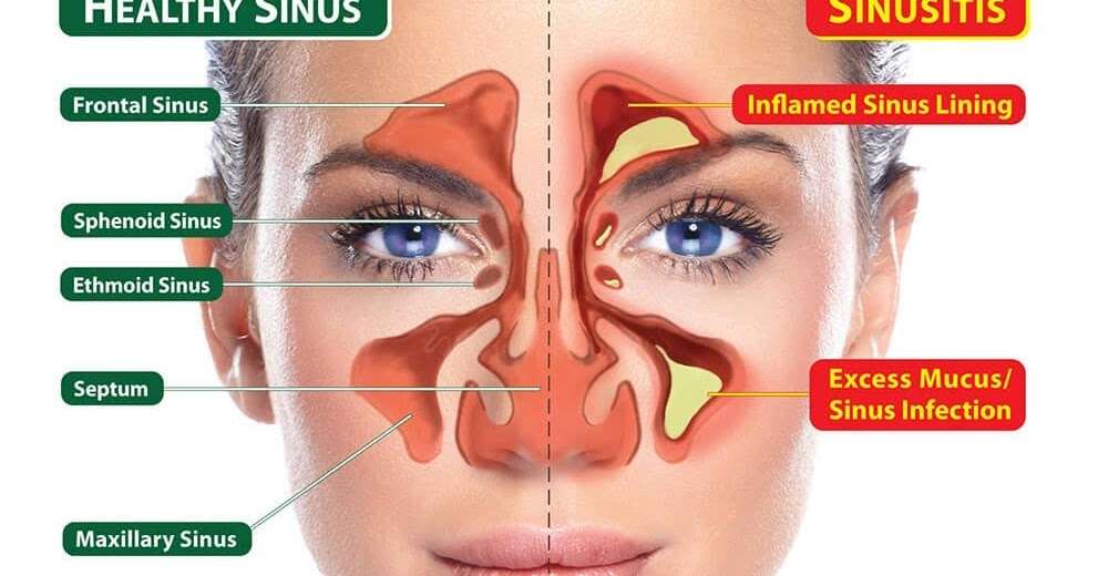 MY eeny weeny Blog: Home Remedies for Sinus Drainage