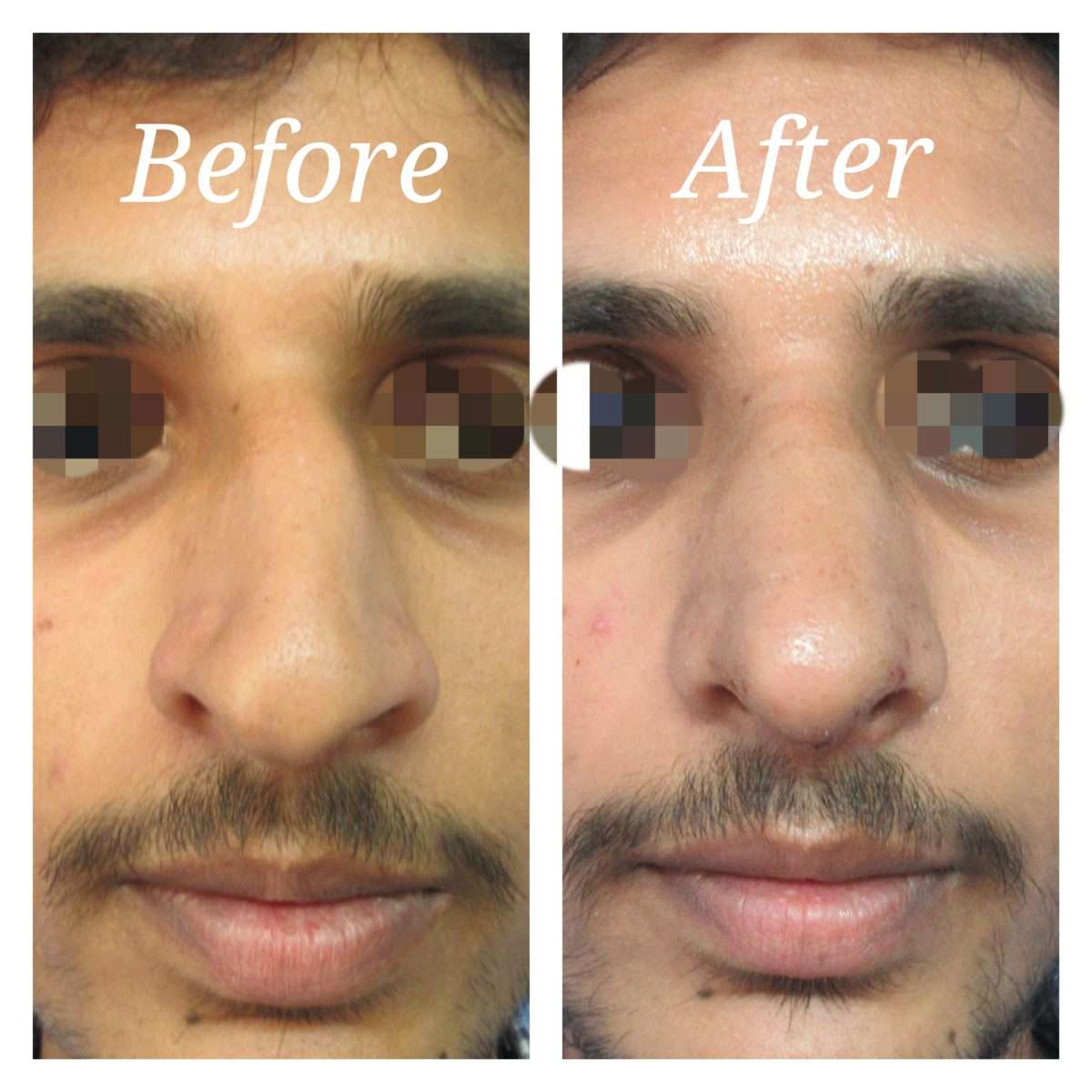Nose Surgery Cost, Bangalore. Leading Nose Reshaping ...