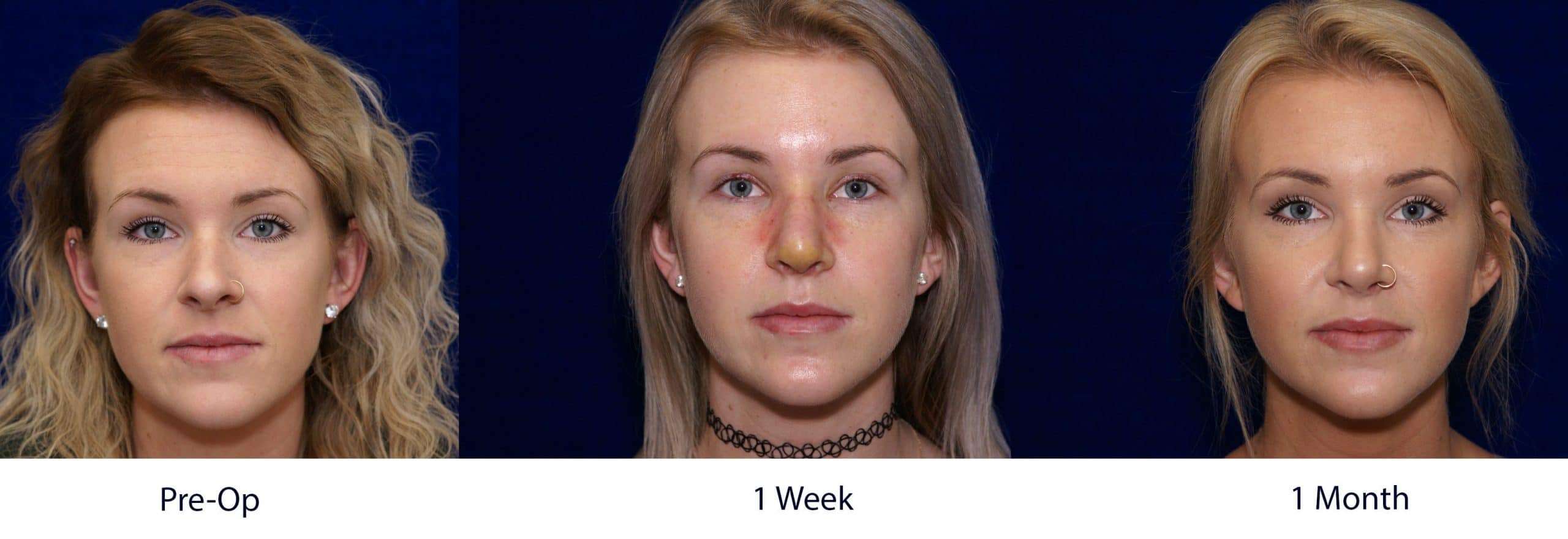 Nose tip swelling after rhinoplasty ...