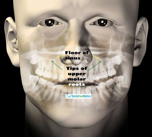 Pain In Nose And Front Teeth