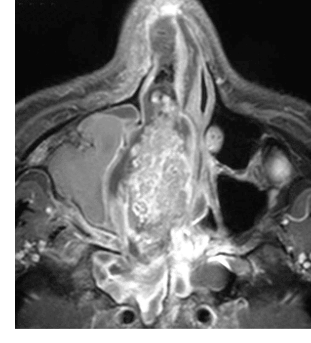 [PDF] Paranasal sinus cancer.