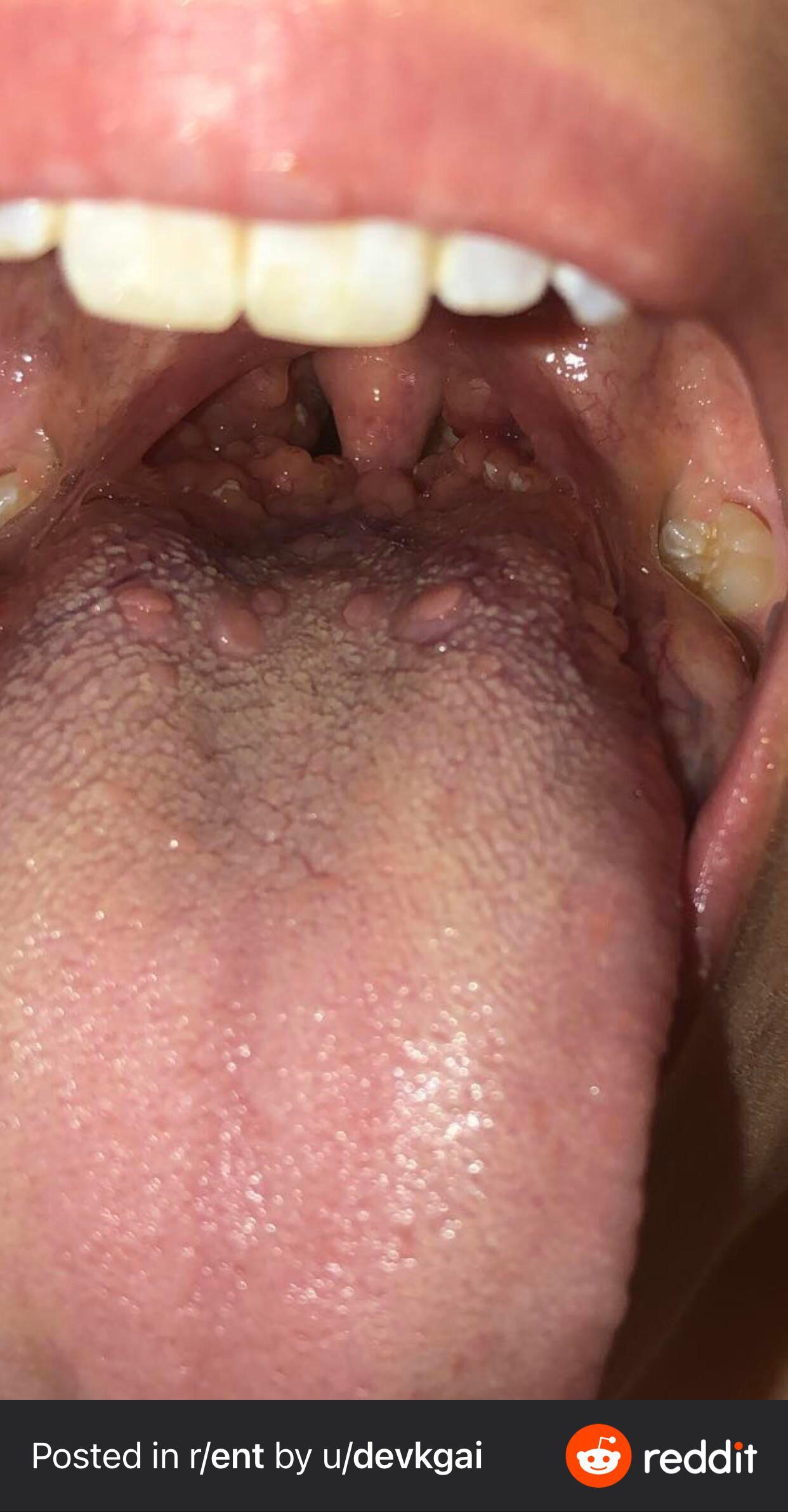 Post nasal drip ? Cobblestone throat? Week and a half in : ent