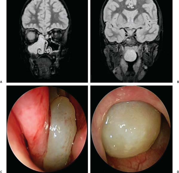 Primary Endoscopic Surgery of the Maxillary Sinus