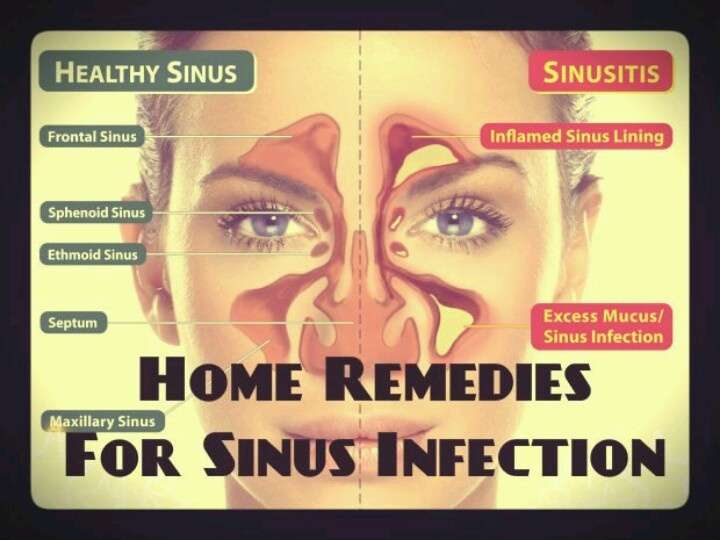 Remedies for sinus infection