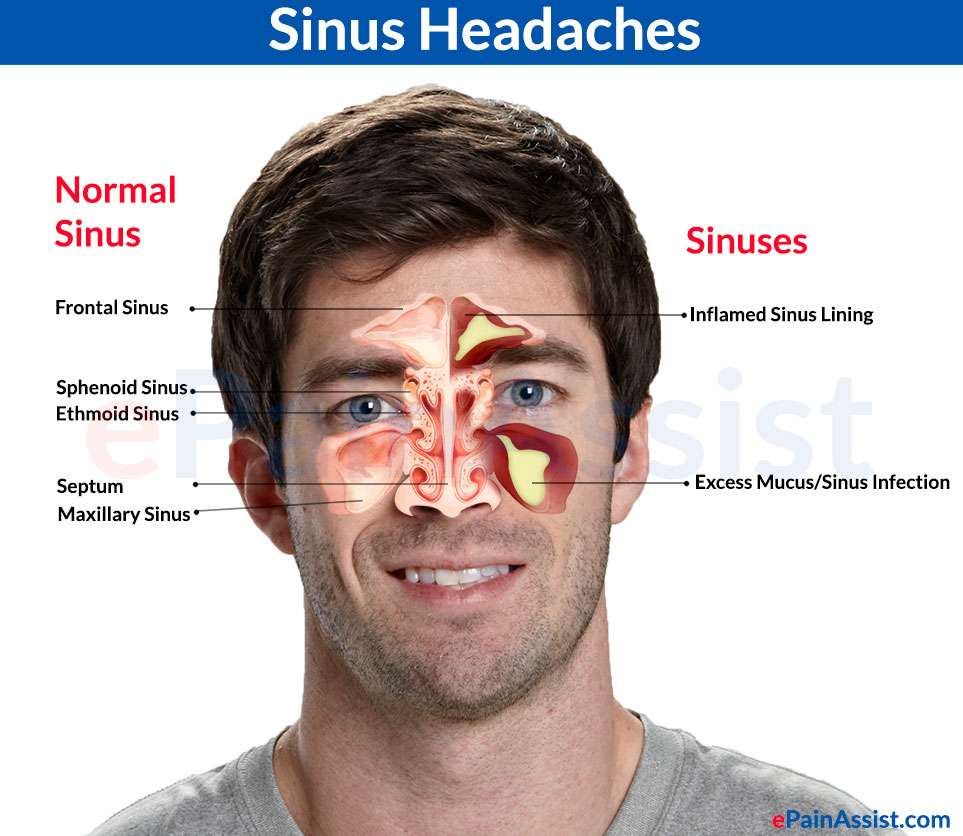 Sinus Headaches: Treatment, Prevention, Differentiating it ...