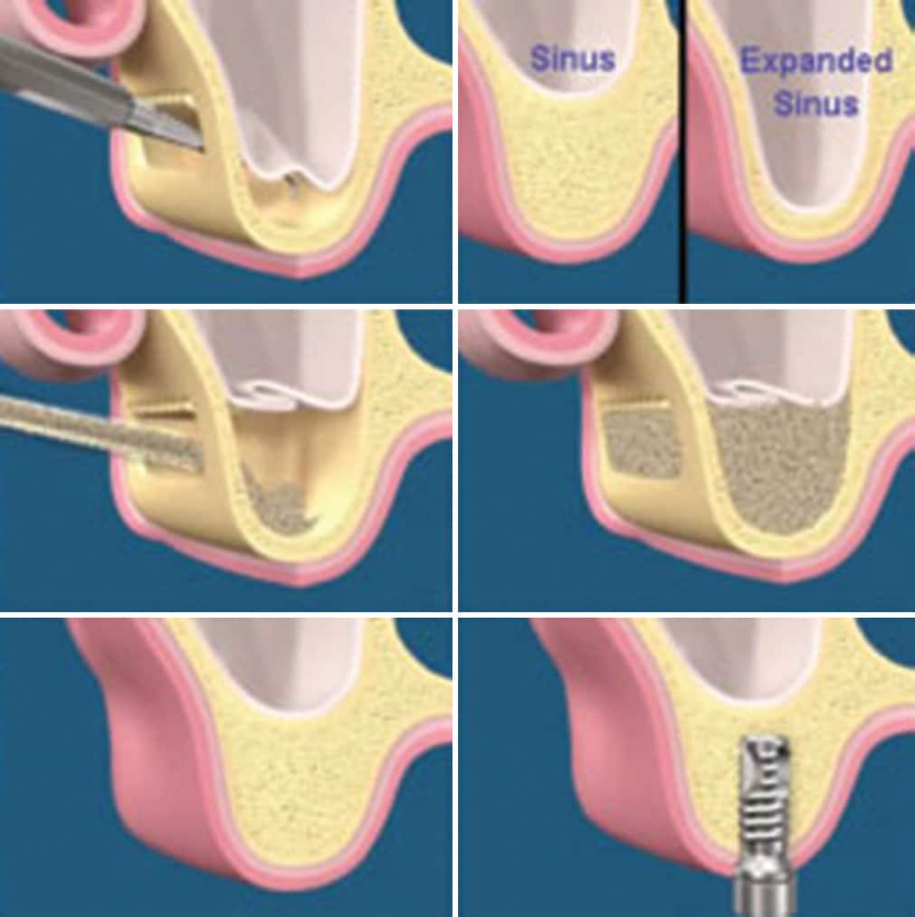 Sinus lift procedures in dental implants: A literature review on ...