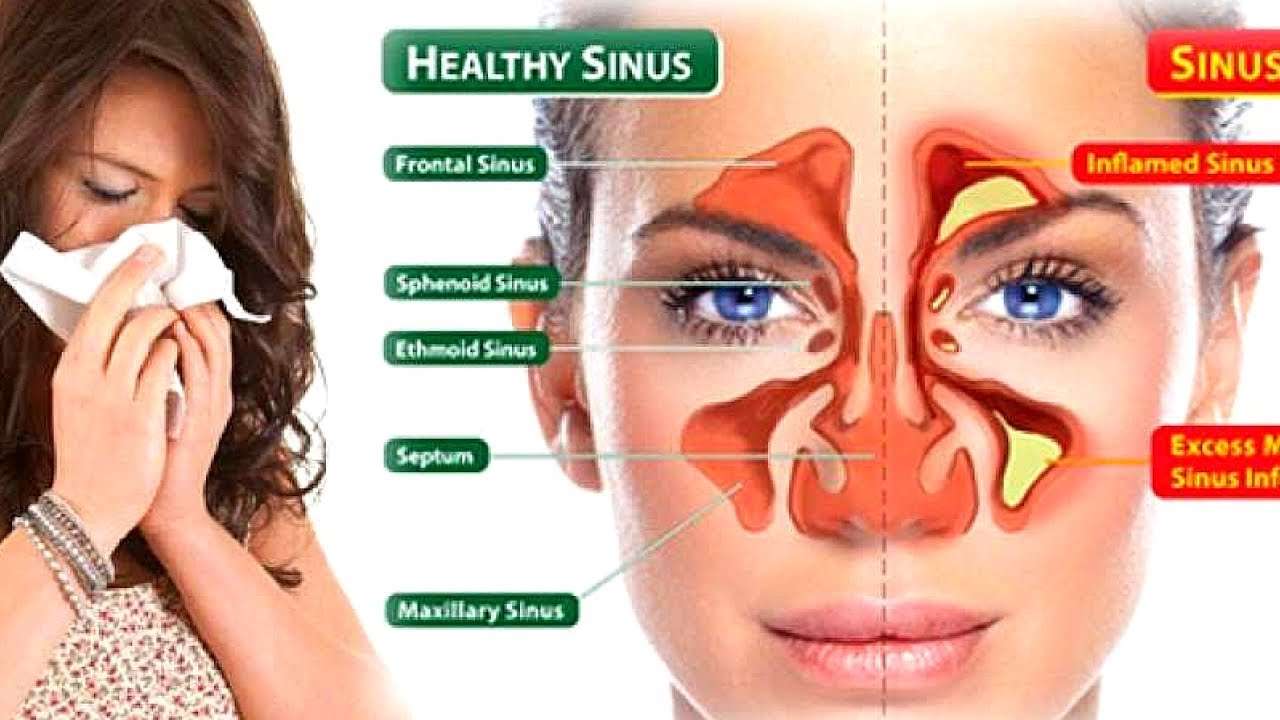 Sinus Points for Drainage and Pressure Relief