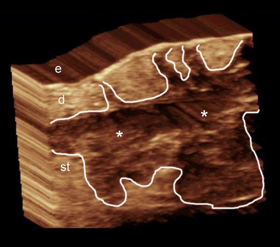 Sinus Tract Formation in Hidradenitis Suppurativa 3D Ultrasound Study ...