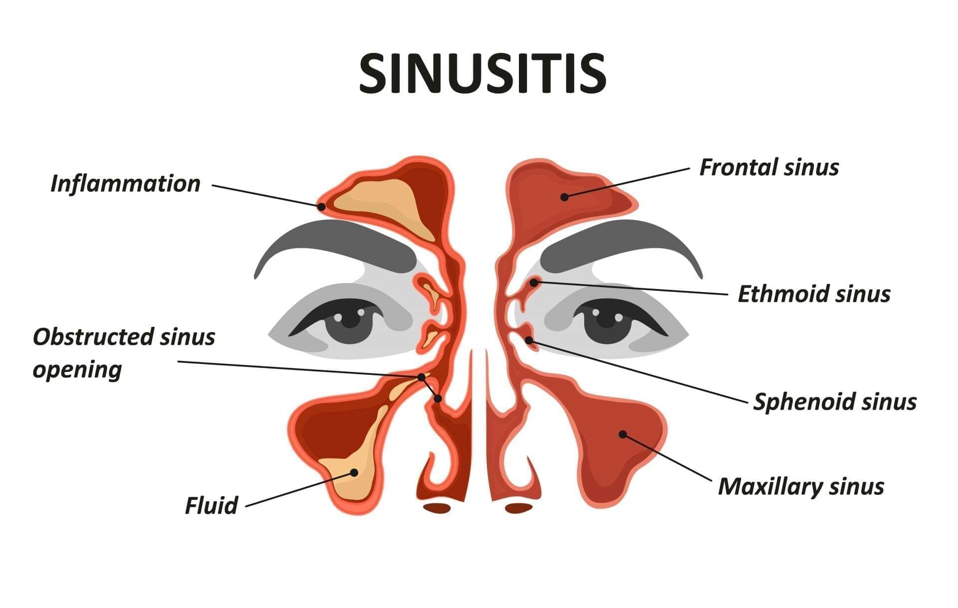 Sinusitis â Ear, Nose + Throat Care Center