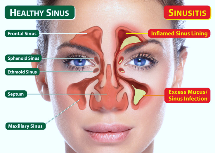 Sinusitis FAQs