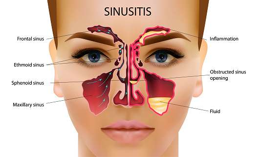Sinusitis Healthy And Inflammation Nasal Sinus Vector ...