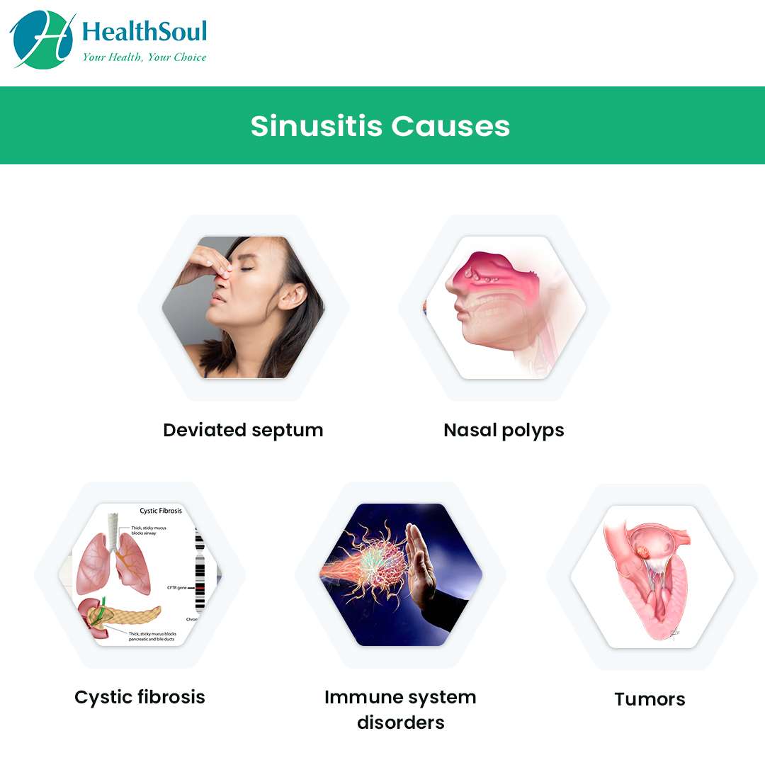 Sinusitis: Symptoms, Diagnosis and Treatment