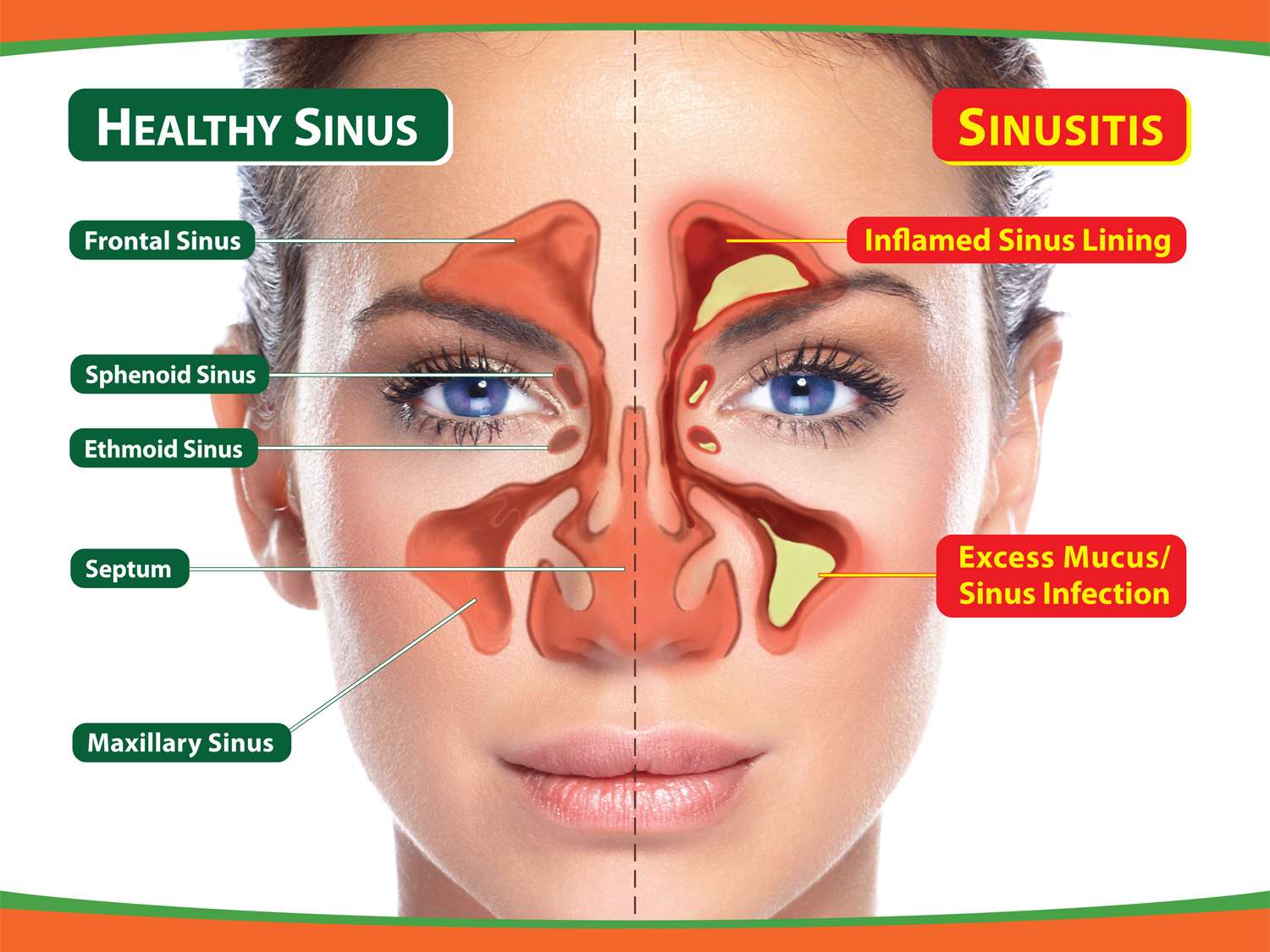 Sinusitis Treatment