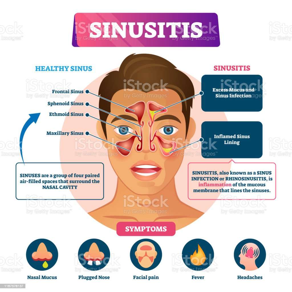 Sinusitis Vector Illustration Labeled Rhinosinusitis Inflammation ...