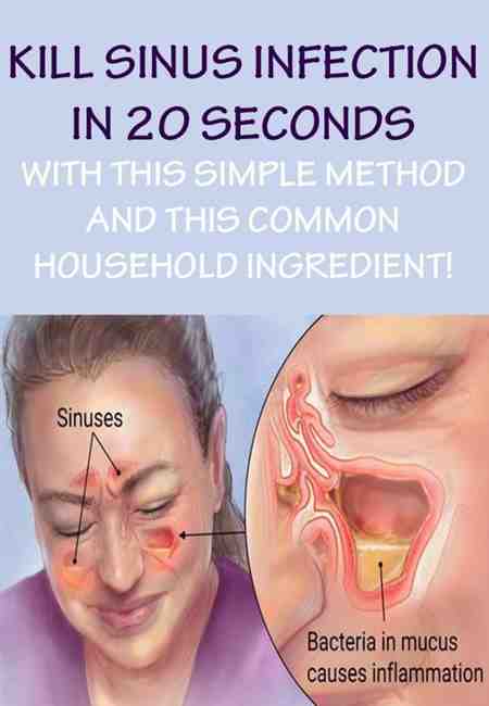 Sinusitis What To Do Remedy Ear Infection Adults ...