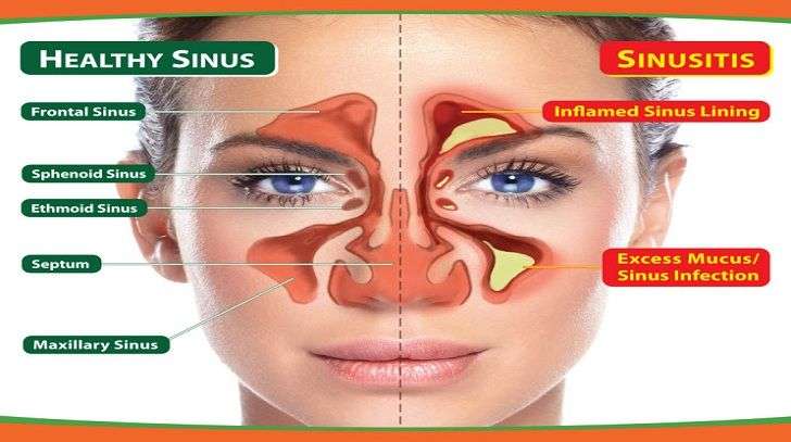 Sinusitis(Sinus Infection): Problems, Symptoms and ...